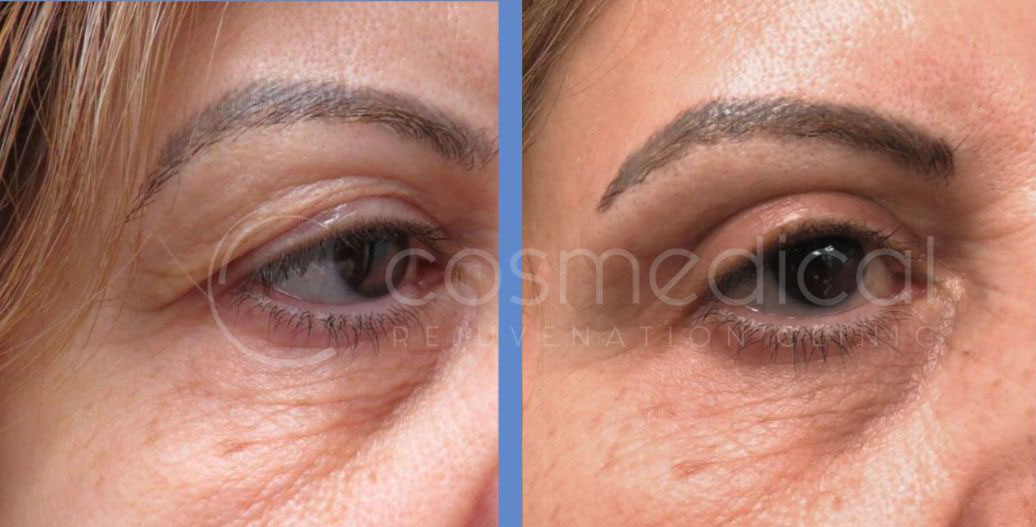 before and after eyelid lift toronto